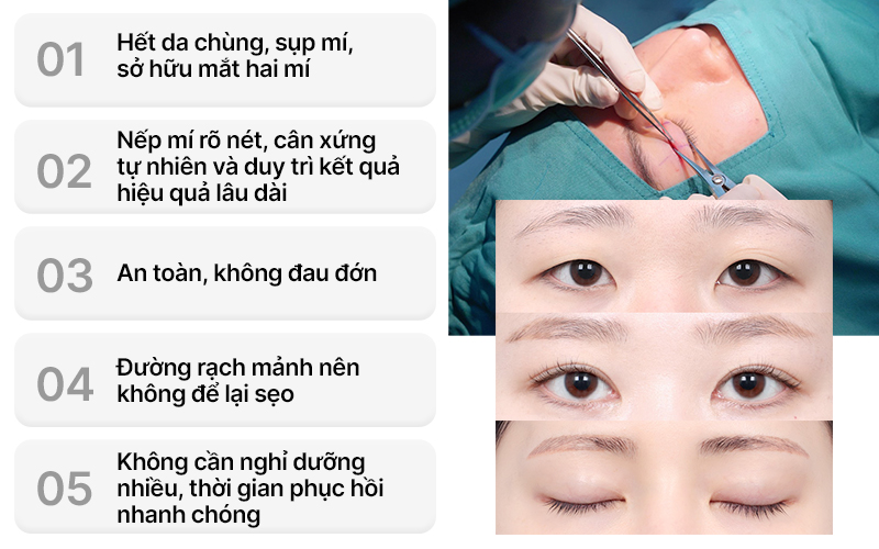 Advantages of creating perfect double eyelids