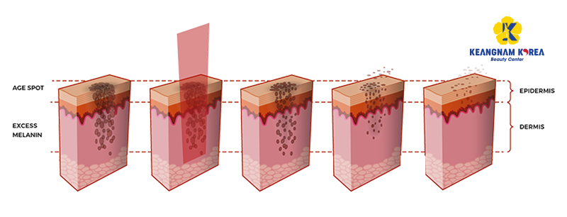 EXO PCELL+ modern melasma removal