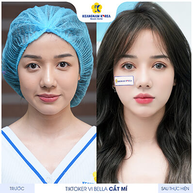 TikToker Vi Bella cắt mí Perfect eyes tại Keangnam Korea