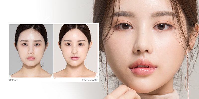 What is Korean eyelid surgery?