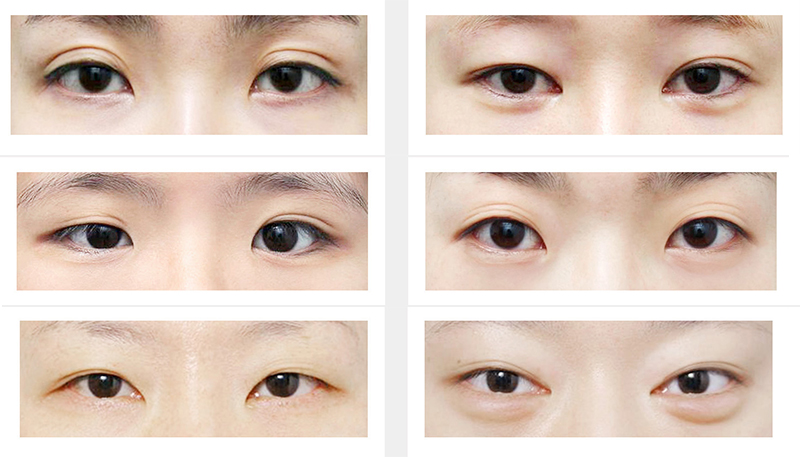 Who should have Korean eye surgery?