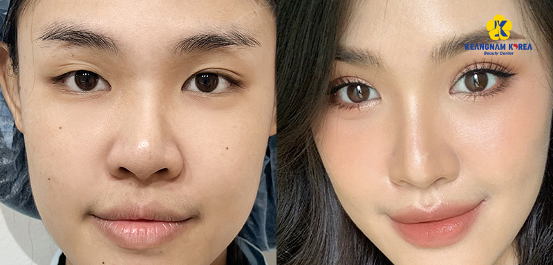 Who should have double eyelid surgery?