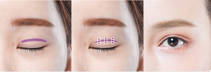 What is double eyelid surgery?