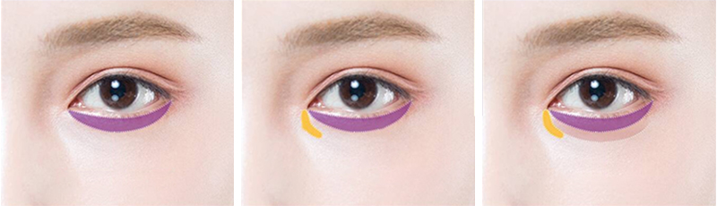 What is lower eyelid surgery?