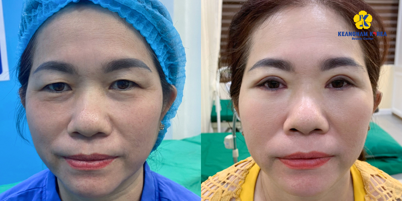 Korean eyelid surgery at Keangnam Korea