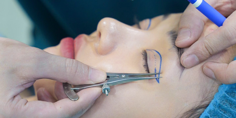 What is eyelid surgery?