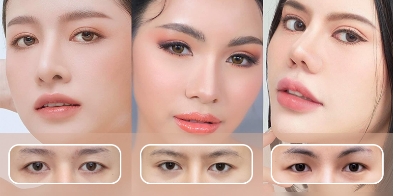 Where to get beautiful, safe and top-quality eyelid surgery?