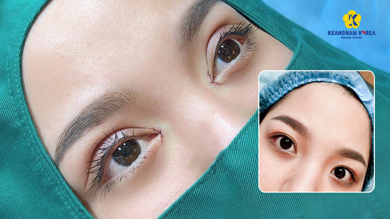 Actual images before and after Korean eyelid surgery at Keangnam Korea