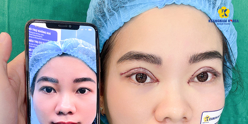 Photos of actual eyelid surgery at Keangnam Korea