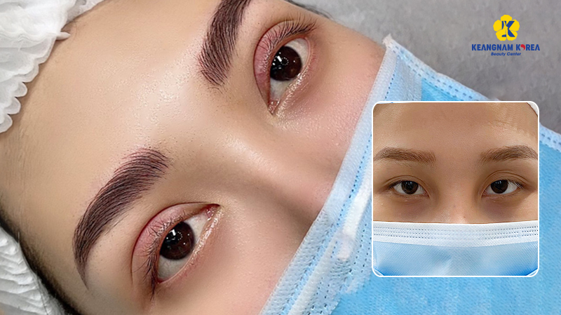 Actual images before and after Korean eye surgery at Keangnam Korea