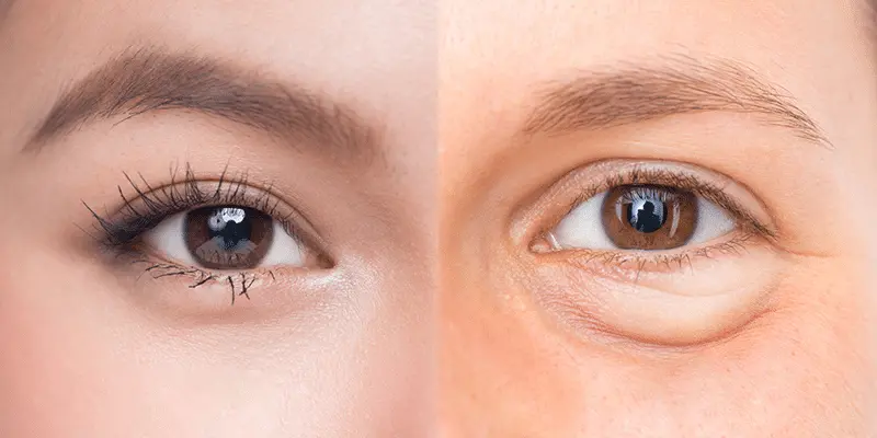 What is the effect of under eye fat removal?