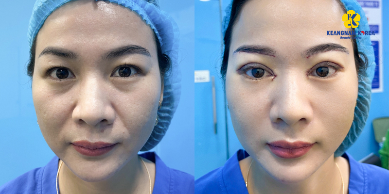 Types of eyelid surgery: double eyelid surgery