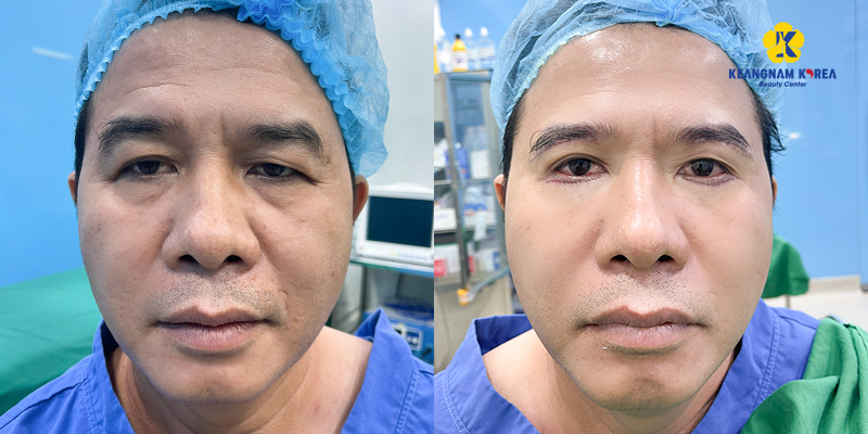 Types of eyelid surgery: lower eyelid surgery