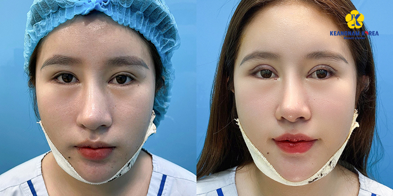 Types of eyelid surgery: upper eyelid surgery