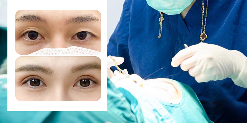 Advantages of Korean eye surgery: Safe