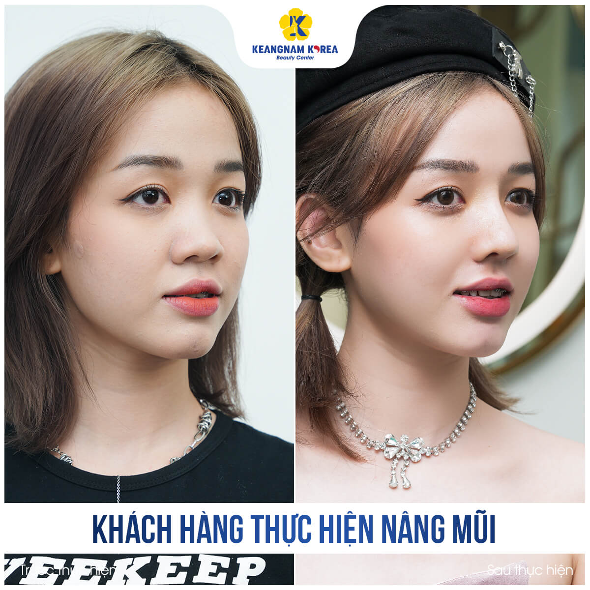 BF_AF_khach-hang-nang-mui-3