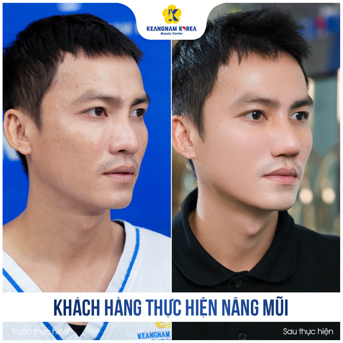 BF_AF_khach-hang-nang-mui-4