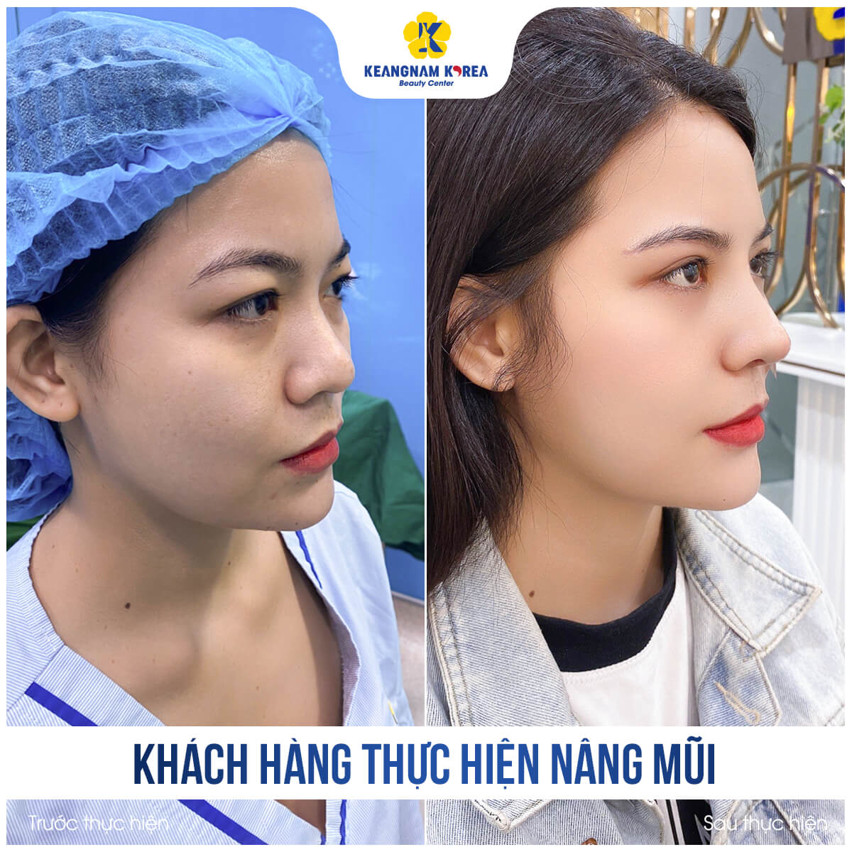 BF_AF_khach-hang-nang-mui-6