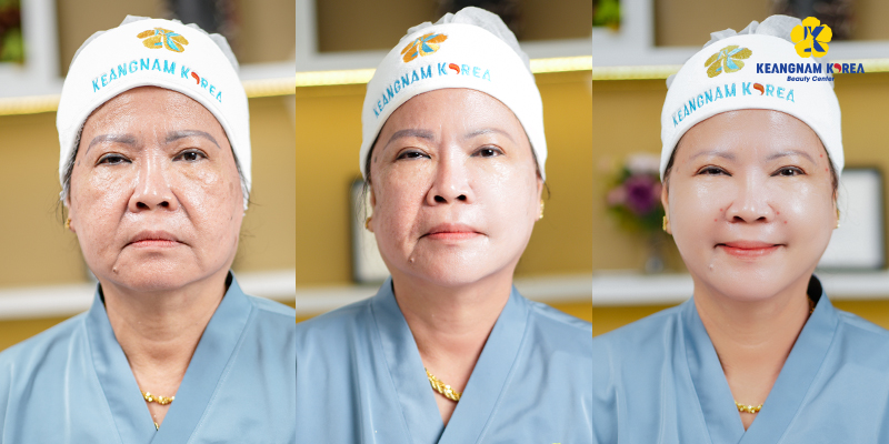 Non-surgical facelift technologies at Keangnam Korea 