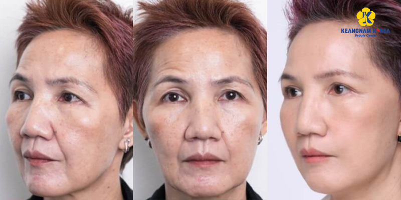 Where to Get a Non-Surgical Facelift?