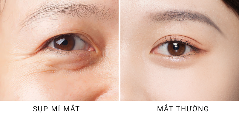 How to Treat Droopy Eyelids for Each Individual