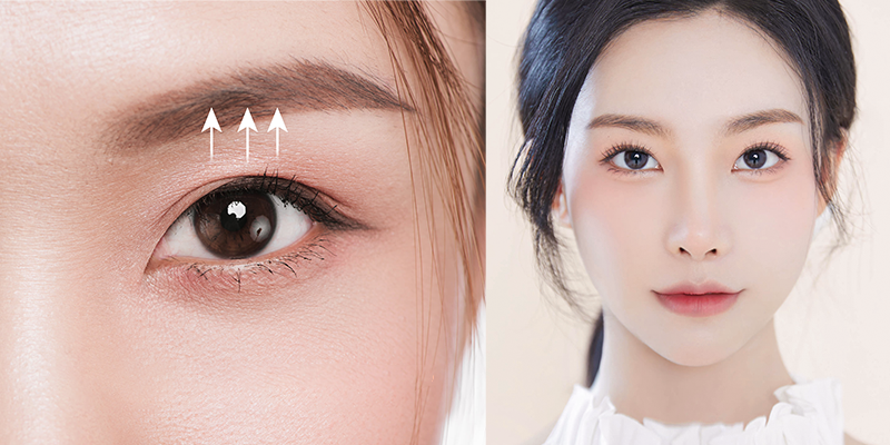 How to Treat Droopy Eyelids