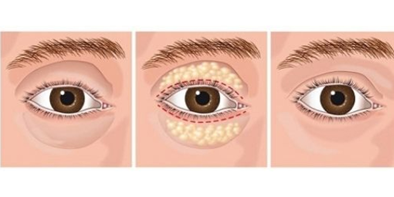 Orbital fat grafting method