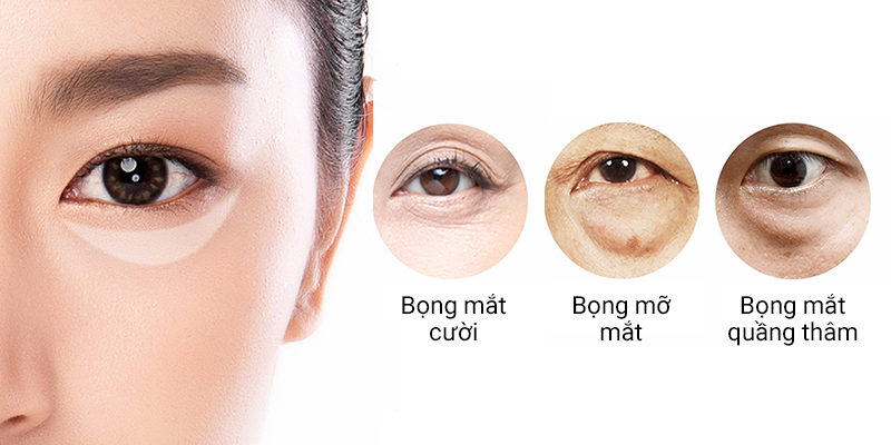 What causes under eye bags?