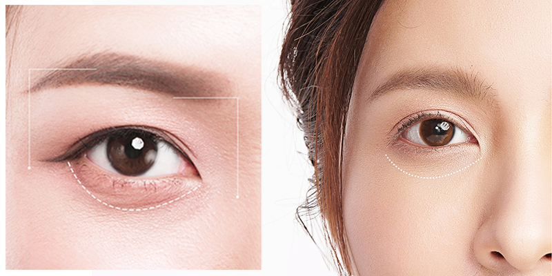 causes of under eye bags