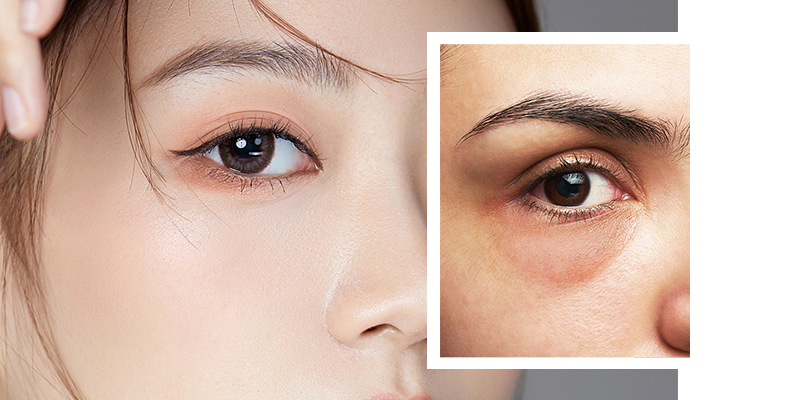 Long-term under eye bag removal