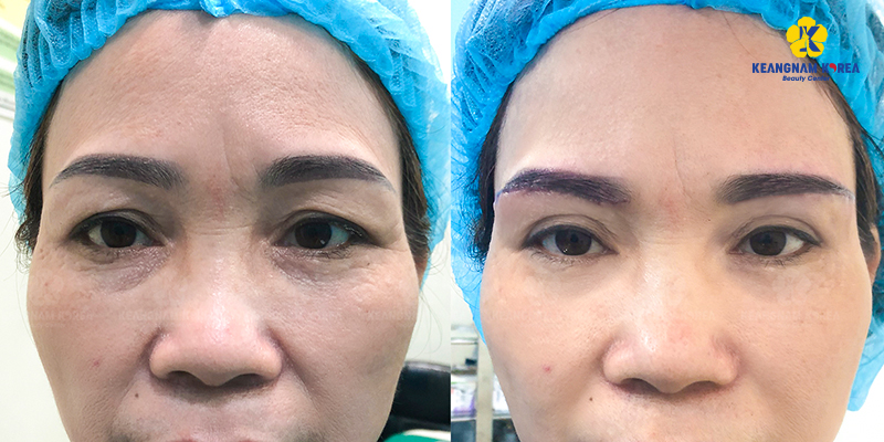 Who Should Consider a Brow Lift?