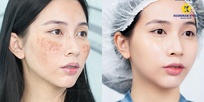 Effective Treatment for Hori Nevus at Keangnam Korea