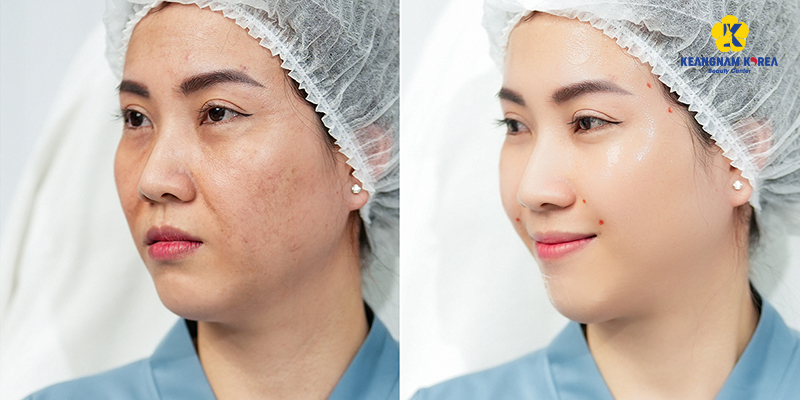 Non-Surgical Treatments for Sagging Facial Skin