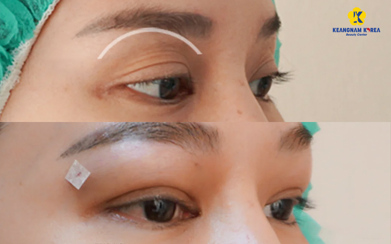 How long does fat grafting for under eye hollows last