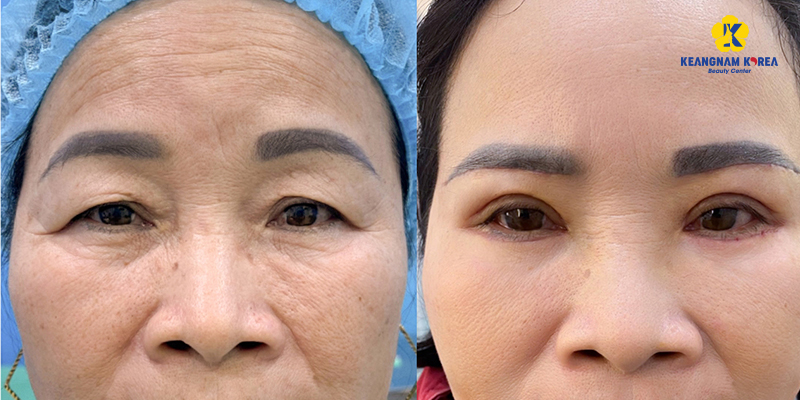 Should I remove eye bags at Keangnam Korea?