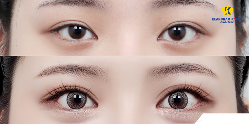 Images of eye corner surgery