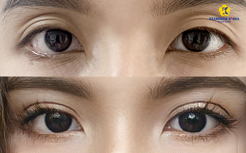 Images of Deep Under Eye Hollow Aesthetic Treatments at Keangnam Korea