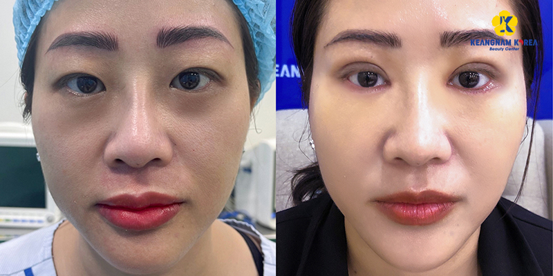 Eye bag removal images at Keangnam Korea