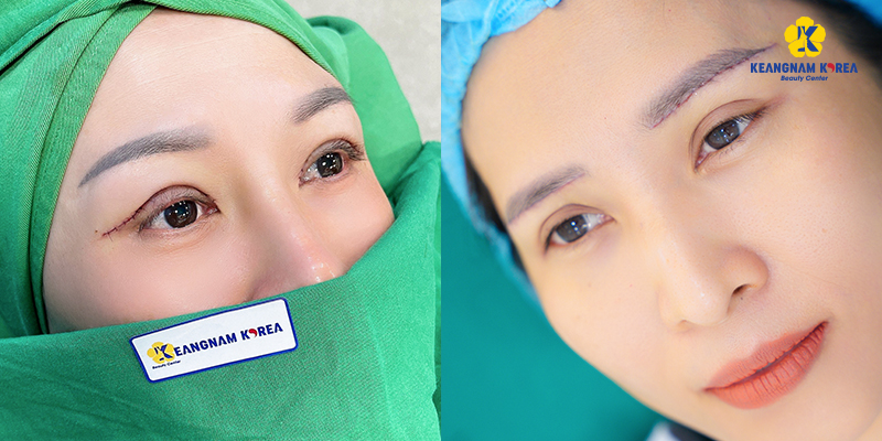 Image of eyelid lift results at Keangnam Korea