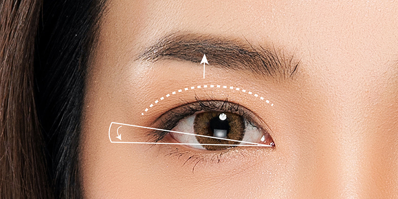 Cost of Eyelid Lift in 2024