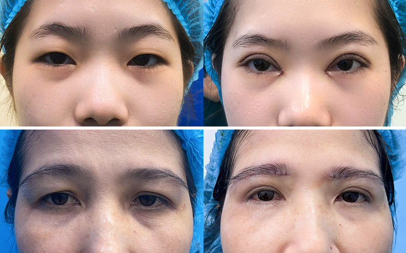 Should You Get Eyelid Surgery or a Brow Lift