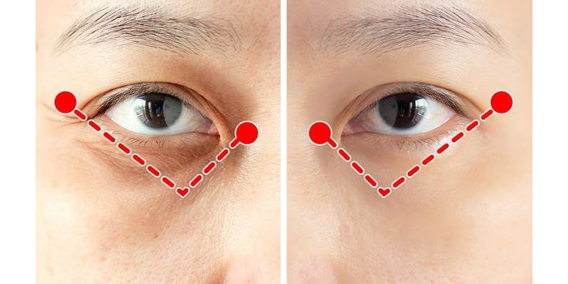 Eyelid Surgery for Droopy Eyelids