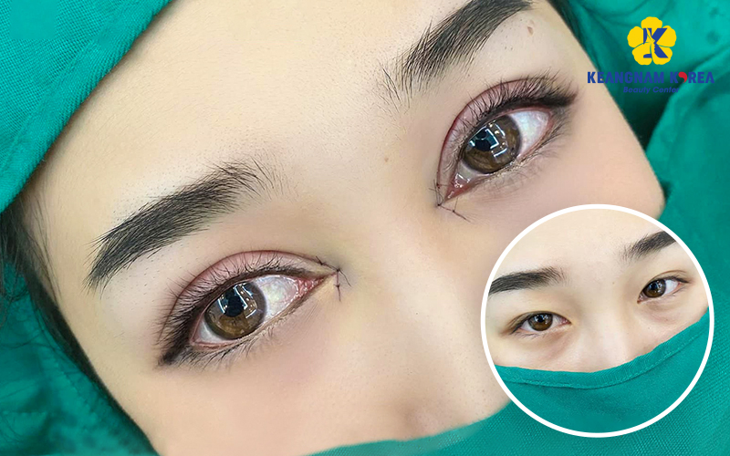 Before and After Eye Corner Surgery