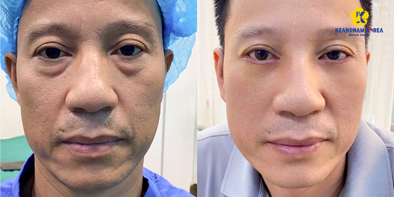 Remove under eye bags for men