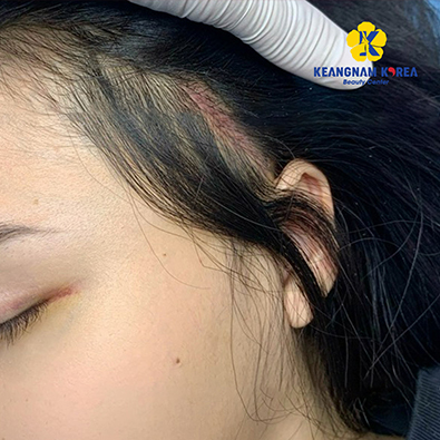 Căng cơ nội soi 54 phkh-3