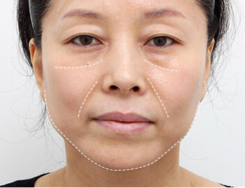 Căng cơ nội soi 6 thcd 1