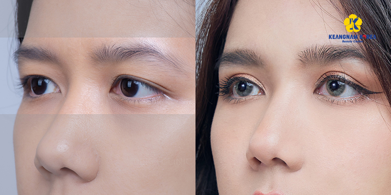 Where can I get eyelid fat removal?