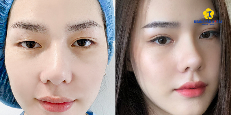 Before-and-after photos of eyelid fat removal surgery