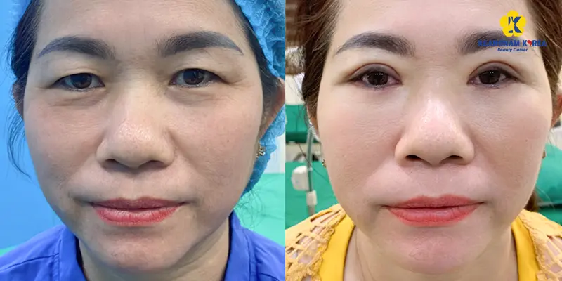 Remove under-eye bags Keangnam Korea