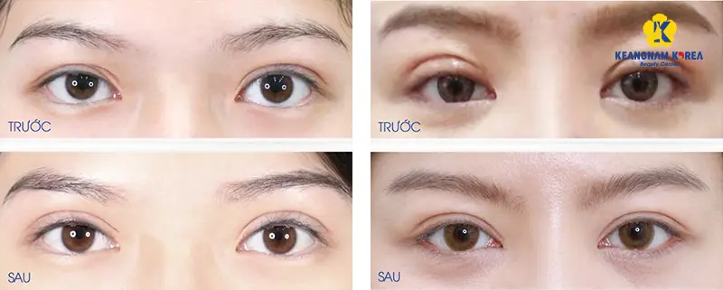 Repairing Failed Eyelid Surgery at Keangnam Korea